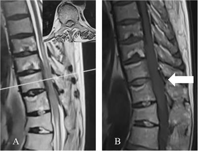 Case report: Clinical highlights and radiological classification of IgG4-related spinal pachymeningitis: A rare case series and updated review of the literature